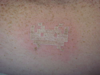 Illustration for article titled Guy Uses Laser-Etch Machine to Tattoo Himself (Verdict: Flaming Nutcase)